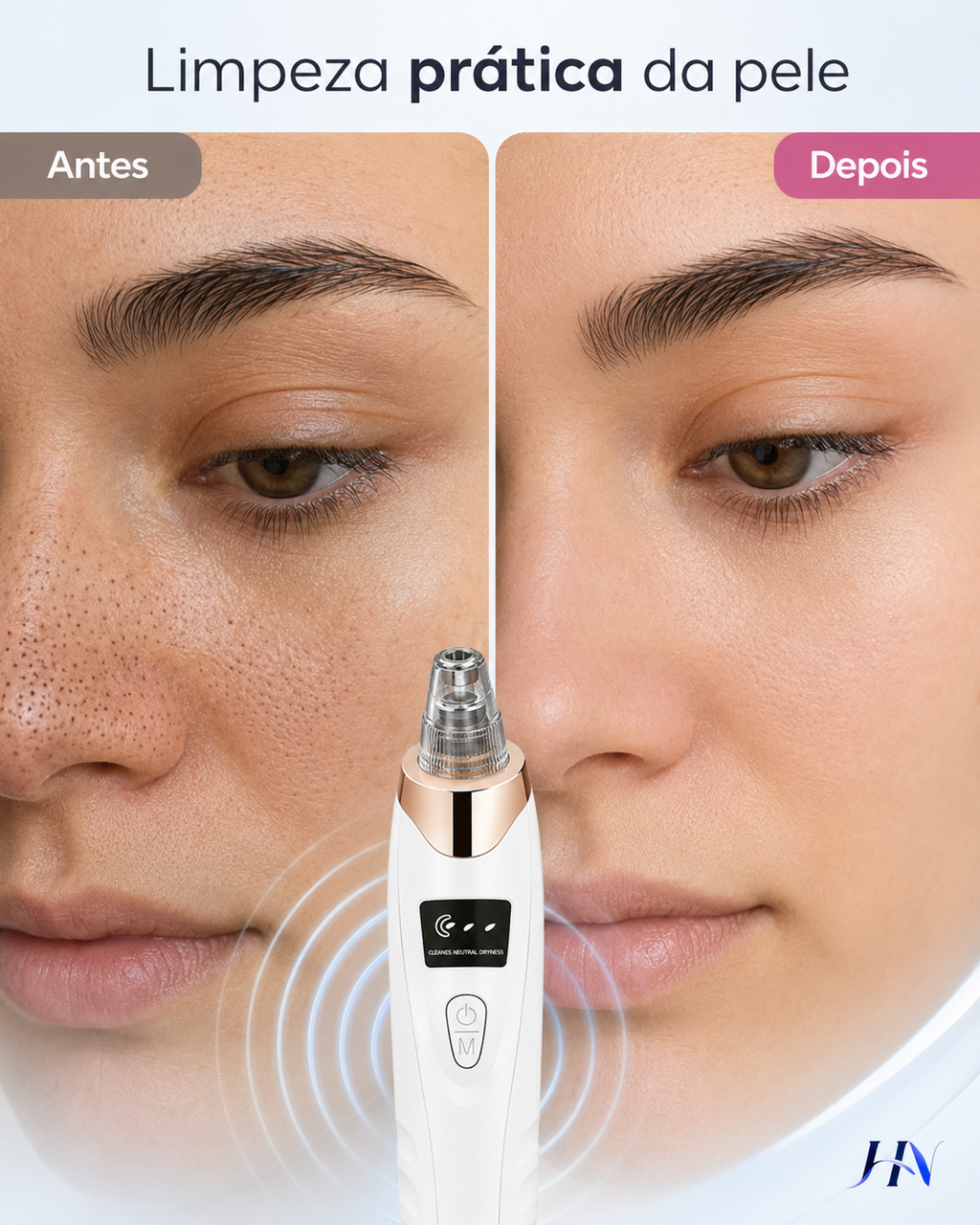 Removedor de Cravos SkinClear Pro – Limpador Facial de Poros para Limpeza Profunda